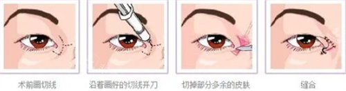 開眼角圖 開眼角圖