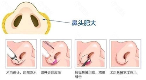 鼻頭肥大圖