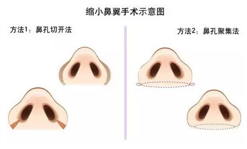 鼻翼縮小圖