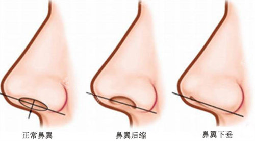 鼻翼圖