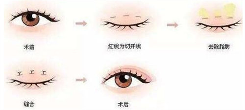 双眼皮手术图