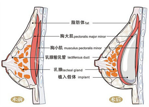 隆胸手术图