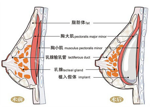 隆胸手術(shù)圖