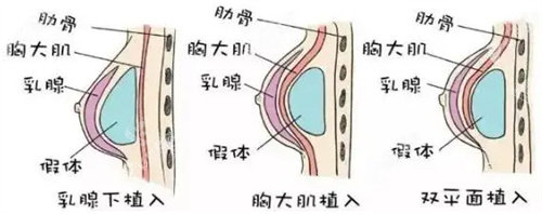 胸部植入圖