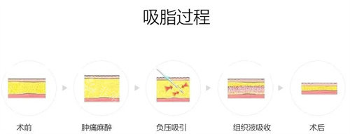 传统吸脂过程展示图 传统吸脂过程展示图