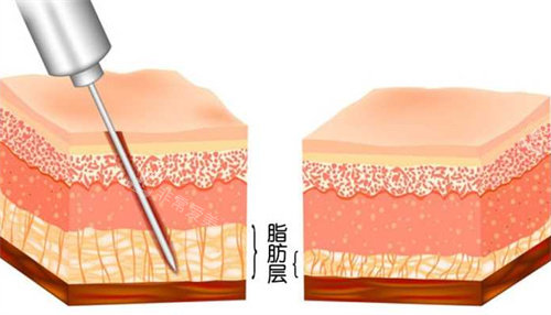 吸脂前后脂肪层变化图 吸脂前后脂肪层变化图
