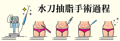 水动力吸脂流程图 水动力吸脂流程图