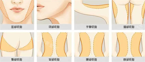 吸脂部位展示图 吸脂部位展示图