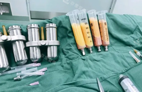 抽吸出来的脂肪照片 抽吸出来的脂肪照片