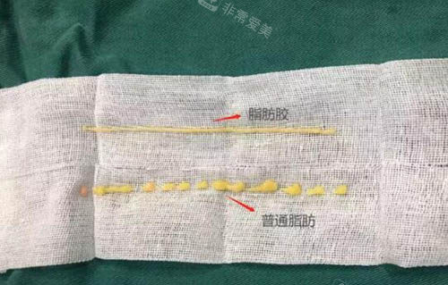 普通脂肪和脂肪胶的区别图 普通脂肪和脂肪胶的区别图