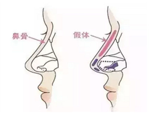 隆鼻假体图