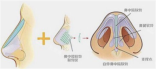 隆鼻图