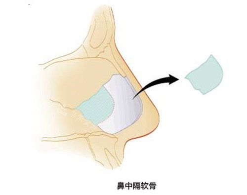 取鼻中隔圖