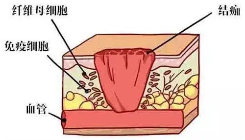 隆鼻后组织图