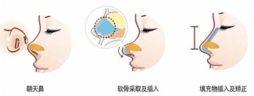 隆鼻圖