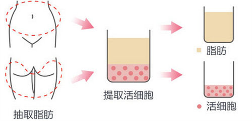 自體脂肪填充流程圖 自體脂肪填充流程圖