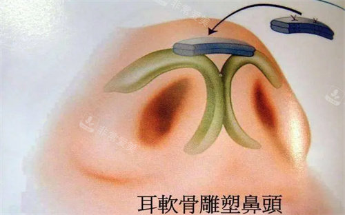 耳軟骨隆鼻 耳軟骨隆鼻
