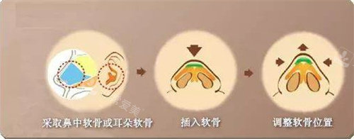 耳軟骨隆鼻圖 耳軟骨隆鼻圖