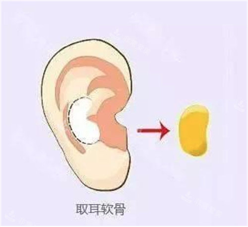 取耳軟骨圖 取耳軟骨圖