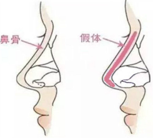 隆鼻假体图