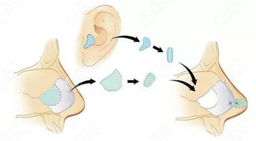 耳软骨隆鼻图