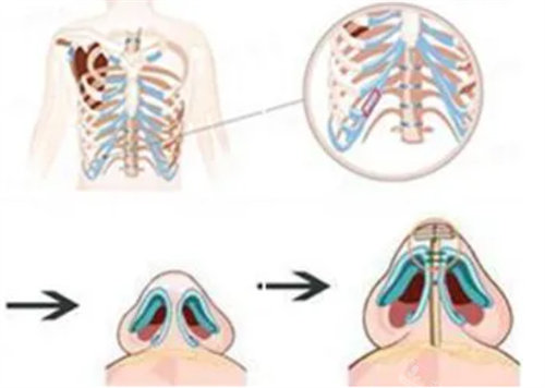 肋骨隆鼻图