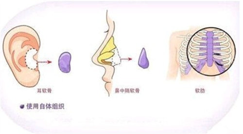 媽生鼻材料圖