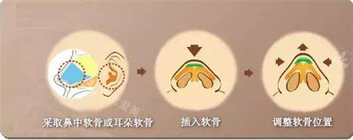 提取耳軟骨圖