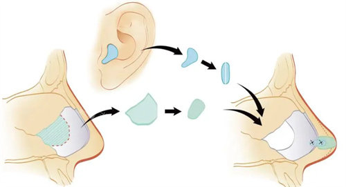 耳軟骨隆鼻圖