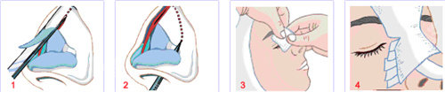 隆鼻手术图