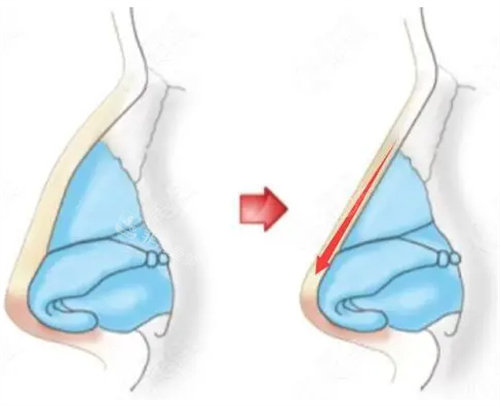 驼峰鼻矫正有后遗症吗？