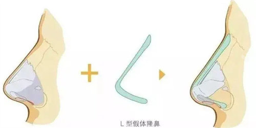 假體隆鼻圖 假體隆鼻圖