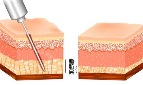 脂肪層前后對比圖 脂肪層前后對比圖