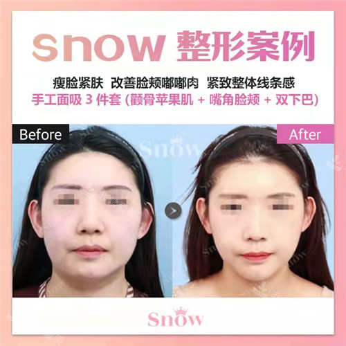 韩国SNOW整形外科手工面吸正面对比