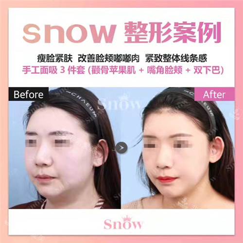 韩国SNOW整形外科手工面吸手术对比照