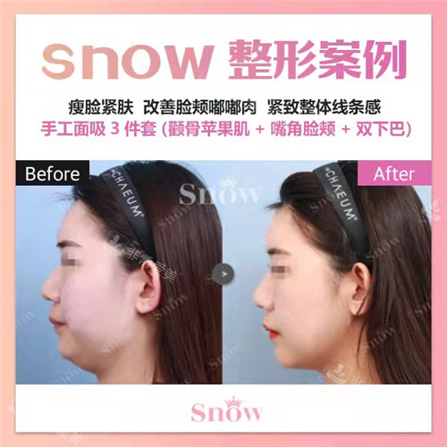 韩国SNOW整形外科手工面吸手术前后图