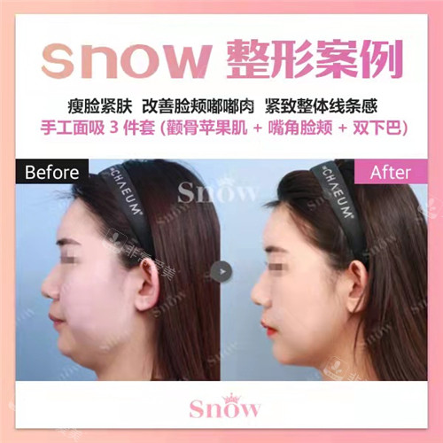 韓國(guó)SNOW整形外科手工面吸手術(shù)前后圖 韓國(guó)SNOW整形外科手工面吸手術(shù)前后圖