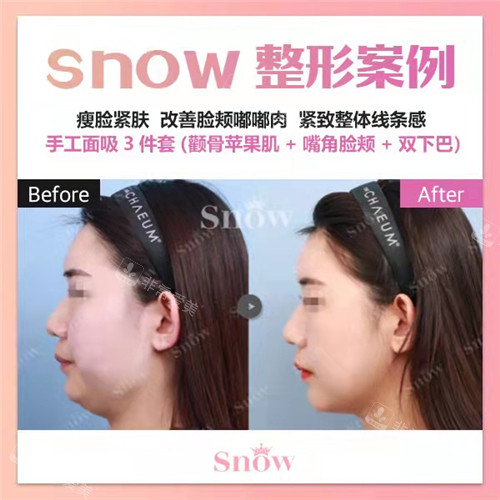 韓國(guó)SNOW整形外科手工面吸手術(shù)前后圖