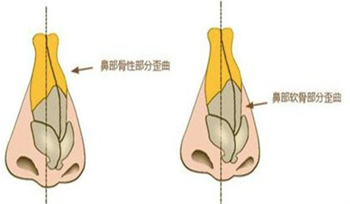 歪鼻矯正圖