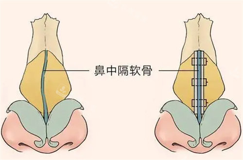 歪鼻形象圖