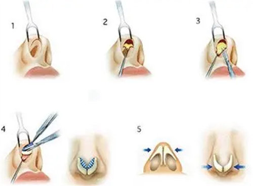 隆鼻手術(shù)操作圖