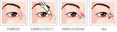 開眼角圖