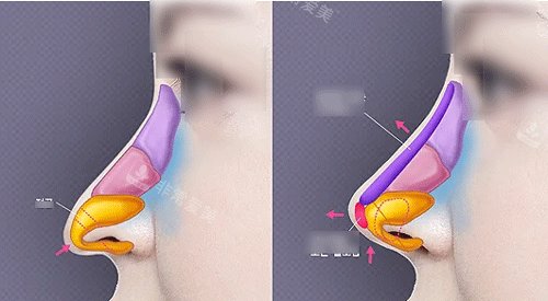 隆鼻细节结构图