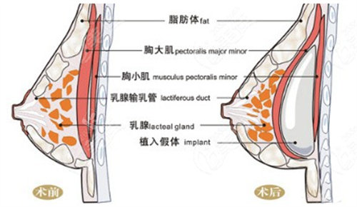 隆胸術(shù)前術(shù)后圖