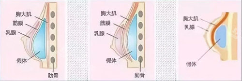 隆胸后的胸和正常胸的区别是什么？