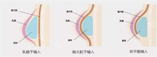 隆胸植入图