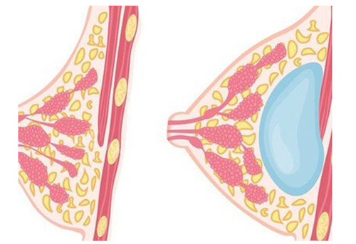 假体隆胸为什么会出现包膜挛缩？