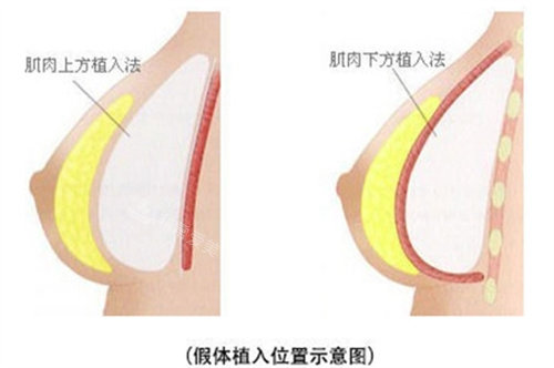 隆胸的植入方式有几种？
