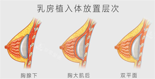 乳房植入方式图