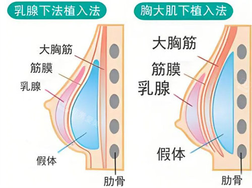 隆胸的植入方式有几种？